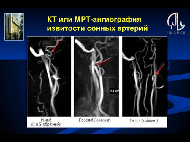 КТ или МРТ-ангиография извитости сонных артерий