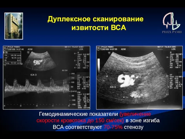 Дуплексное сканирование извитости ВСА Гемодинамические показатели (увеличение скорости кровотока до 150 см/сек)