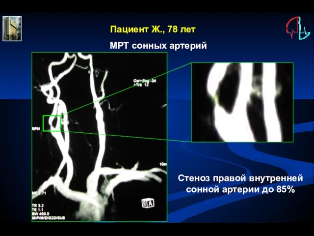 Пациент Ж., 78 лет МРТ сонных артерий Стеноз правой внутренней сонной артерии до 85%