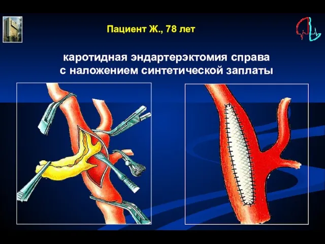 Пациент Ж., 78 лет каротидная эндартерэктомия справа с наложением синтетической заплаты