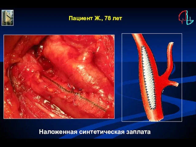 Наложенная синтетическая заплата Пациент Ж., 78 лет
