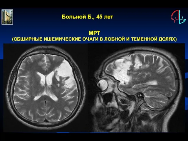 Больной Б., 45 лет МРТ (ОБШИРНЫЕ ИШЕМИЧЕСКИЕ ОЧАГИ В ЛОБНОЙ И ТЕМЕННОЙ ДОЛЯХ)