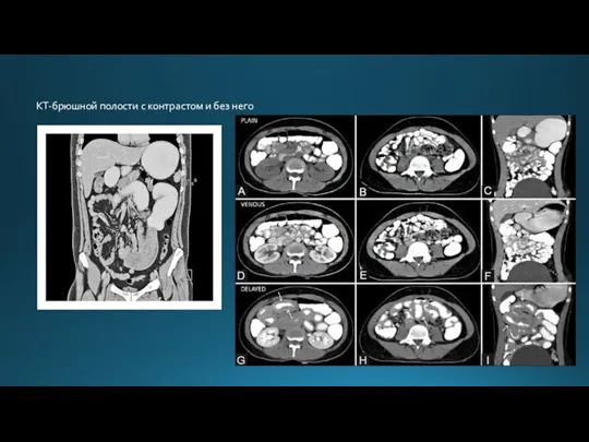КТ-брюшной полости с контрастом и без него