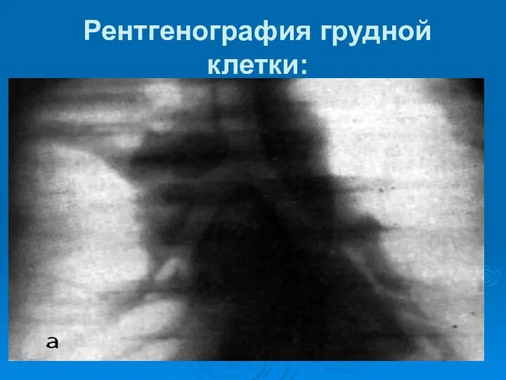 Рентгенография грудной клетки: