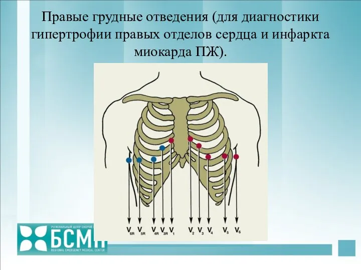 Правые грудные отведения (для диагностики гипертрофии правых отделов сердца и инфаркта миокарда ПЖ).