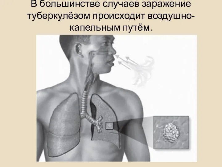 В большинстве случаев заражение туберкулёзом происходит воздуш­но-капельным путём.