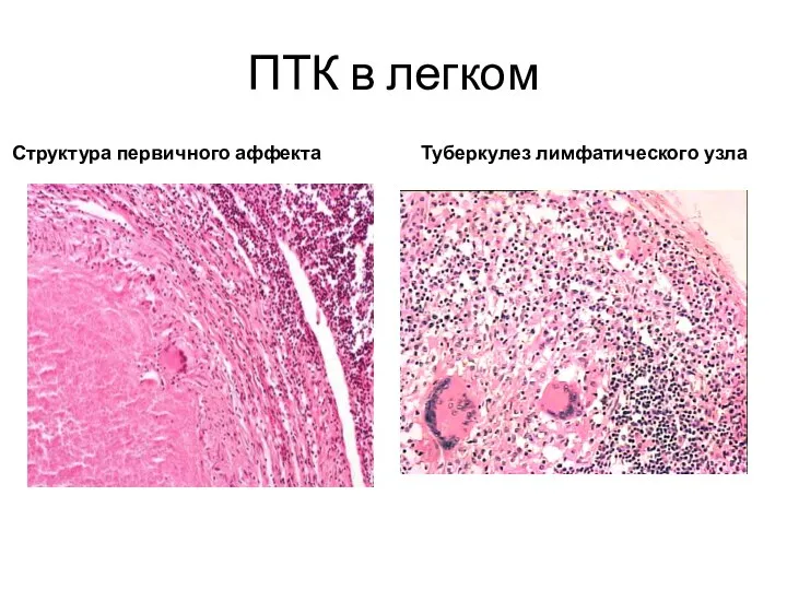 ПТК в легком Структура первичного аффекта Туберкулез лимфатического узла