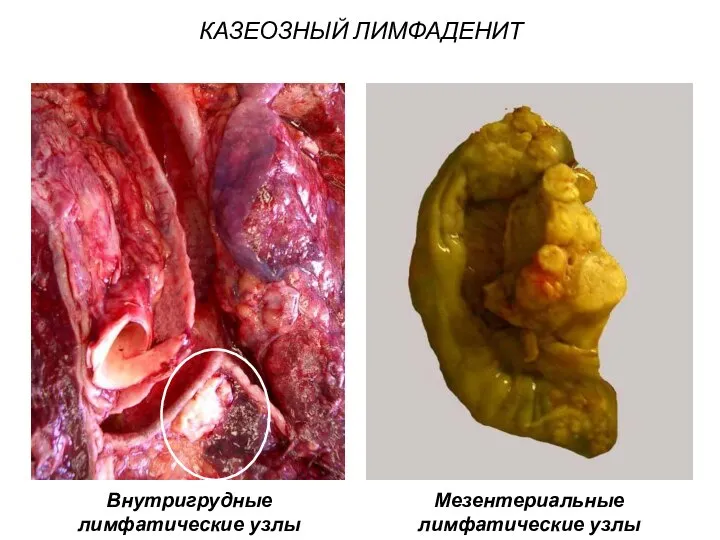 КАЗЕОЗНЫЙ ЛИМФАДЕНИТ Внутригрудные лимфатические узлы Мезентериальные лимфатические узлы