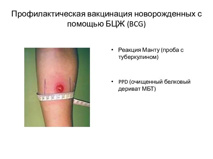 Профилактическая вакцинация новорожденных с помощью БЦЖ (BCG) Реакция Манту (проба с туберкулином)