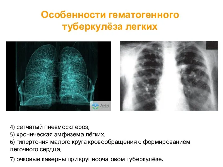 Особенности гематогенного туберкулёза легких 4) сетчатый пневмосклероз, 5) хроническая эмфизема лёгких, 6)