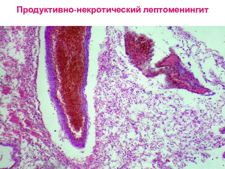 Продуктивно-некротический лептоменингит