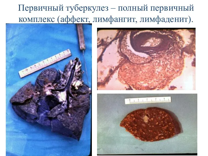 Первичный туберкулез – полный первичный комплекс (аффект, лимфангит, лимфаденит).