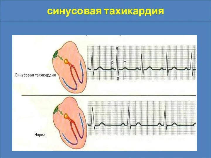 синусовая тахикардия