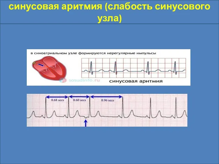 синусовая аритмия (слабость синусового узла)