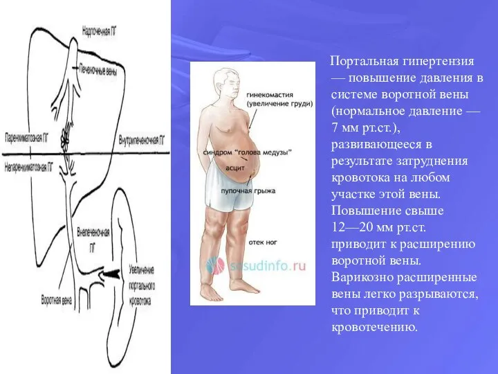 Портальная гипертензия — повышение давления в системе воротной вены (нормальное давление —