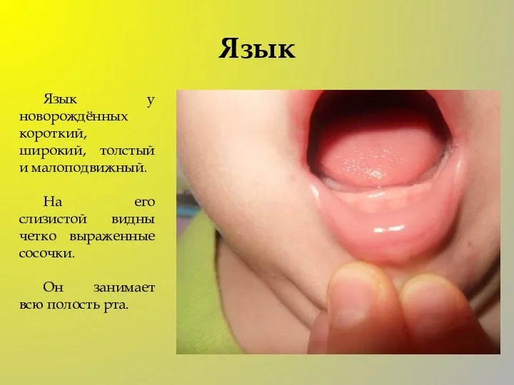 Язык Язык у новорождённых короткий, широкий, толстый и малоподвижный. На его слизистой