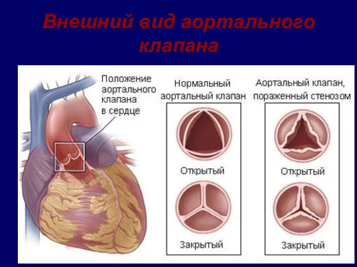 Внешний вид аортального клапана