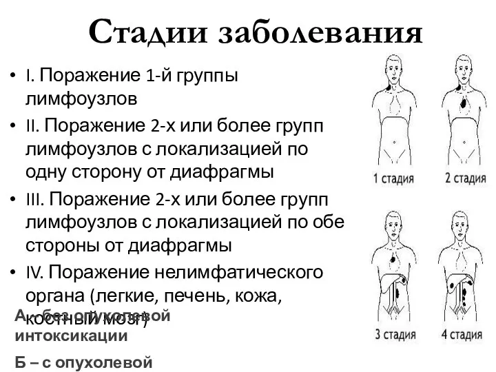 Стадии заболевания I. Поражение 1-й группы лимфоузлов II. Поражение 2-х или более