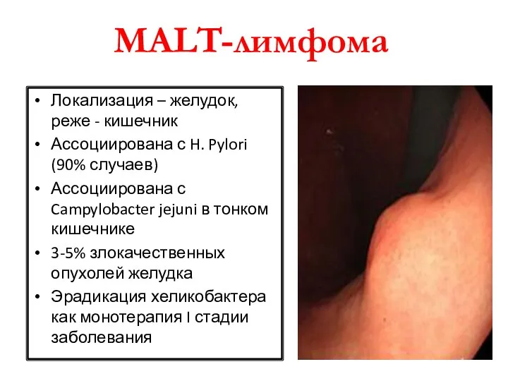 MALT-лимфома Локализация – желудок, реже - кишечник Ассоциирована с H. Pylori (90%