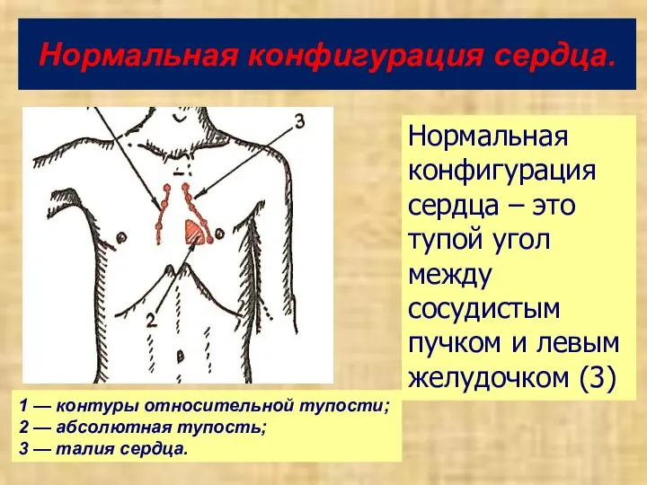 Нормальная конфигурация сердца. 1 — контуры относительной тупости; 2 — абсолютная тупость;