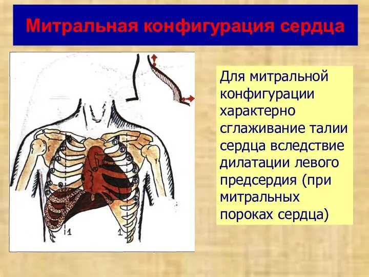 Митральная конфигурация сердца Для митральной конфигурации характерно сглаживание талии сердца вследствие дилатации