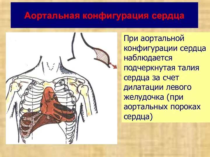 Аортальная конфигурация сердца При аортальной конфигурации сердца наблюдается подчеркнутая талия сердца за