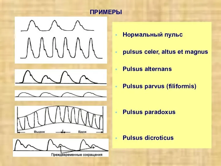 ПРИМЕРЫ Нормальный пульс pulsus celer, altus et magnus Pulsus alternans Pulsus parvus