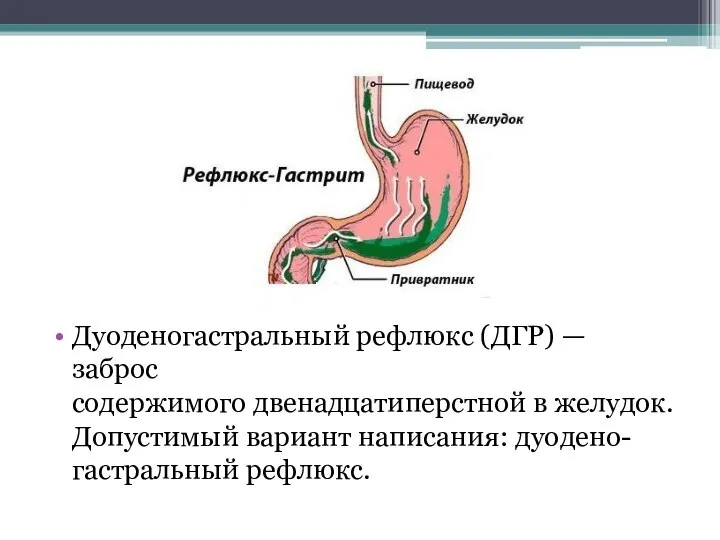 Дуоденогастральный рефлюкс (ДГР) — заброс содержимого двенадцатиперстной в желудок. Допустимый вариант написания: дуодено-гастральный рефлюкс.