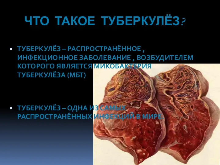 ЧТО ТАКОЕ ТУБЕРКУЛЁЗ? ТУБЕРКУЛЁЗ – РАСПРОСТРАНЁННОЕ , ИНФЕКЦИОННОЕ ЗАБОЛЕВАНИЕ , ВОЗБУДИТЕЛЕМ КОТОРОГО