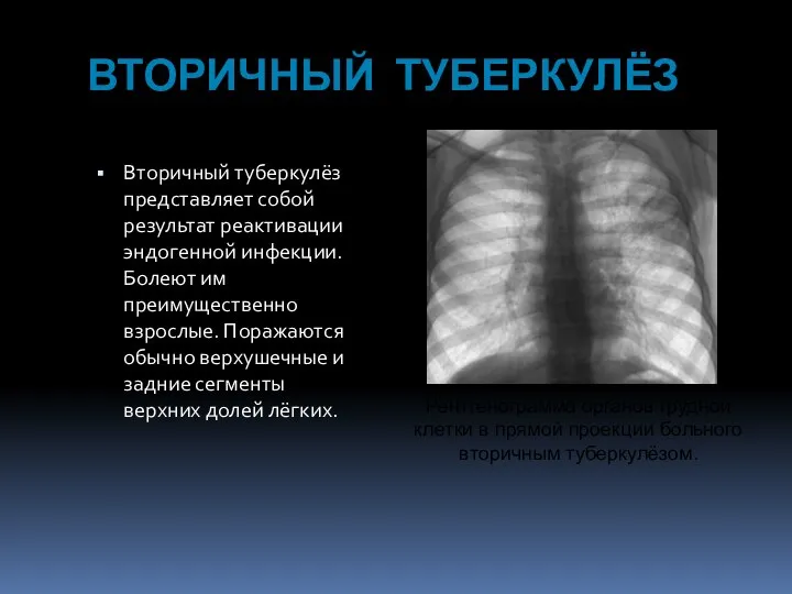 ВТОРИЧНЫЙ ТУБЕРКУЛЁЗ Вторичный туберкулёз представляет собой результат реактивации эндогенной инфекции. Болеют им