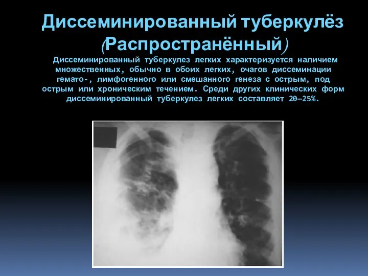 Диссеминированный туберкулёз (Распространённый) Диссеминированный туберкулез легких характеризуется наличием множественных, обычно в обоих