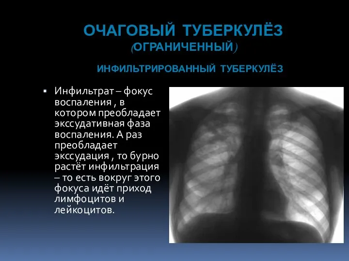 ОЧАГОВЫЙ ТУБЕРКУЛЁЗ (ОГРАНИЧЕННЫЙ) Инфильтрат – фокус воспаления , в котором преобладает экссудативная