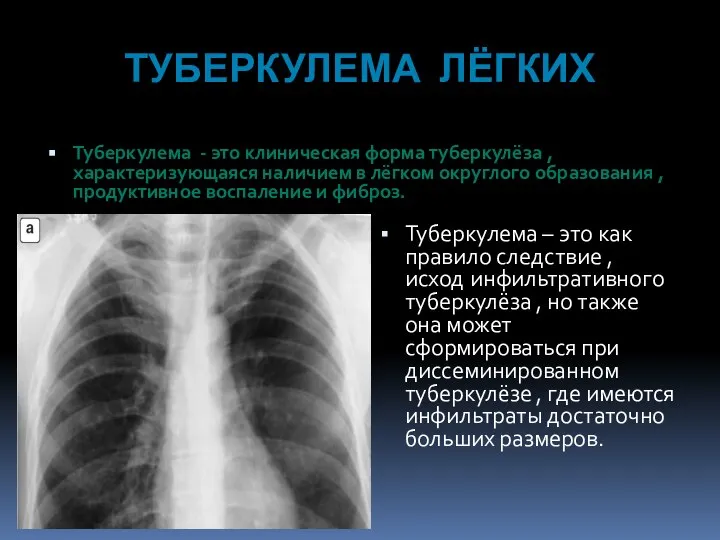 ТУБЕРКУЛЕМА ЛЁГКИХ Туберкулема - это клиническая форма туберкулёза , характеризующаяся наличием в