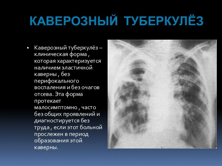КАВЕРОЗНЫЙ ТУБЕРКУЛЁЗ Каверозный туберкулёз – клиническая форма , которая характеризуется наличием эластичной