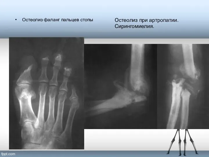 Остеолиз фаланг пальцев стопы Остеолиз при артропатии. Сирингомиелия.