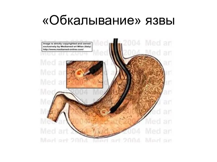 «Обкалывание» язвы