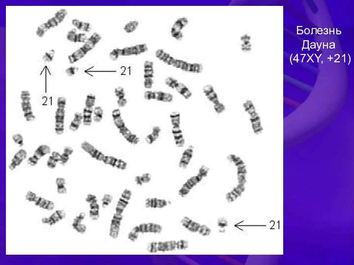 Болезнь Дауна (47XY, +21)