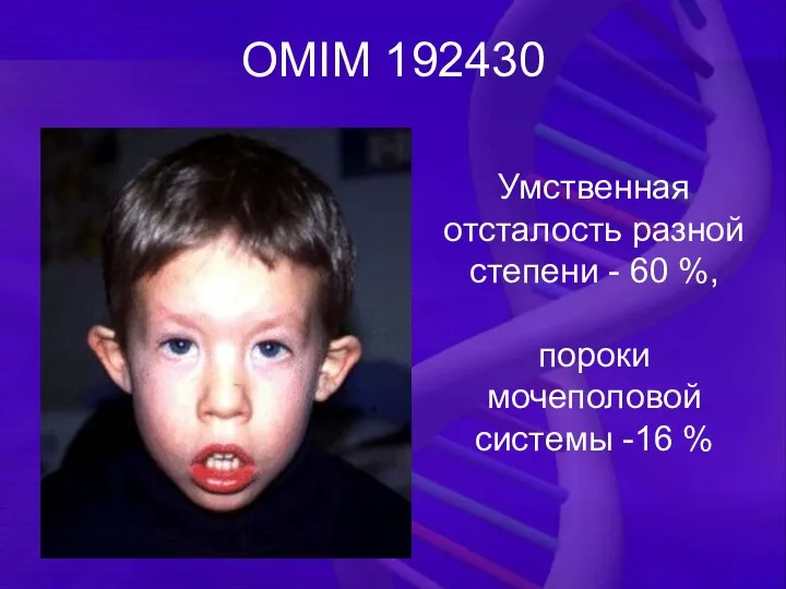 OMIM 192430 Умственная отсталость разной степени - 60 %, пороки мочеполовой системы -16 %