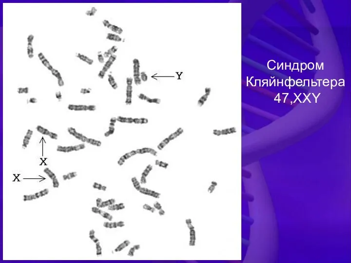 Синдром Кляйнфельтера 47,XXY