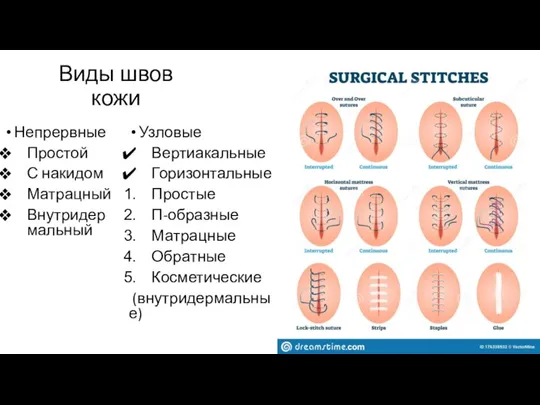 Непрервные Простой С накидом Матрацный Внутридермальный Узловые Вертиакальные Горизонтальные Простые П-образные Матрацные