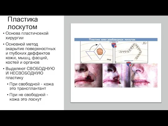 Пластика лоскутом Основа пластичсекой хирургии Основной метод зкарытие поверхностных и глубоких деффектов