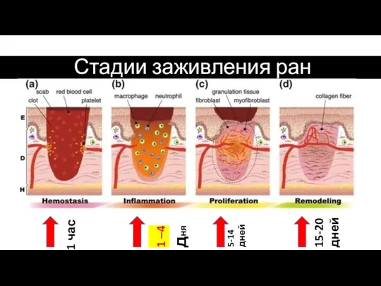 Стадии заживления ран 15-20 дней 1 час 5-14 дней 1 –4 дня