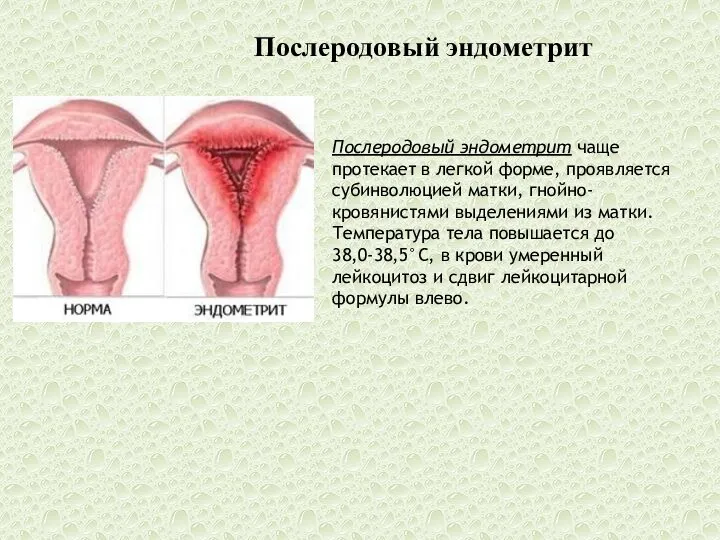 Послеродовый эндометрит Послеродовый эндометрит чаще протекает в легкой форме, проявляется субинволюцией матки,