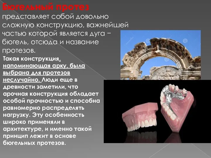 Бюгельный протез представляет собой довольно сложную конструкцию, важнейшей частью которой является дуга