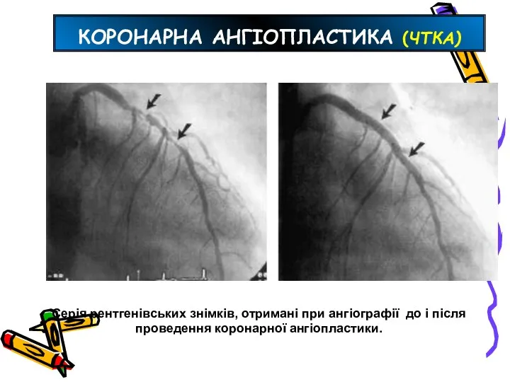 КОРОНАРНА АНГІОПЛАСТИКА (ЧТКА) Серія рентгенівських знімків, отримані при ангіографії до і після проведення коронарної ангіопластики.