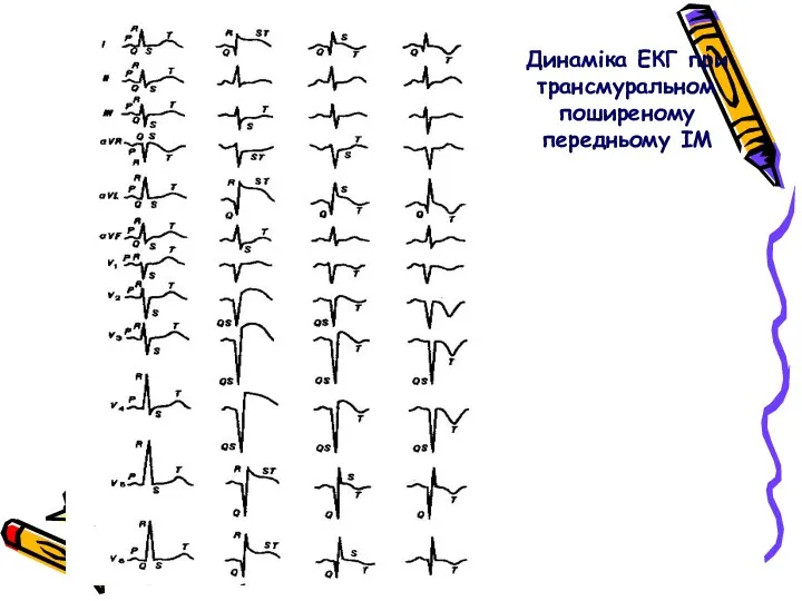 Динаміка ЕКГ при трансмуральном поширеному передньому ІМ