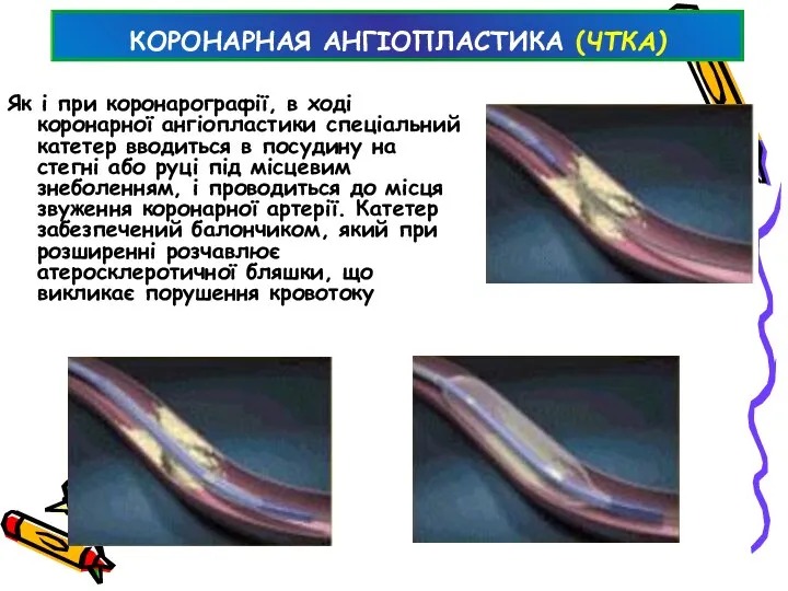 КОРОНАРНАЯ АНГІОПЛАСТИКА (ЧТКА) Як і при коронарографії, в ході коронарної ангіопластики спеціальний