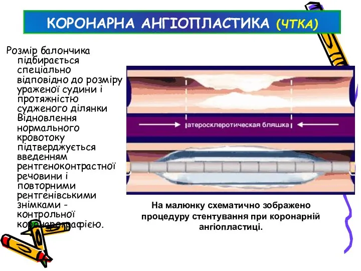 КОРОНАРНА АНГІОПЛАСТИКА (ЧТКА) Розмір балончика підбирається спеціально відповідно до розміру ураженої судини