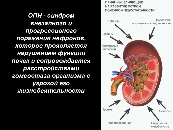 ОПН - синдром внезапного и прогрессивного поражения нефронов, которое проявляется нарушением функции