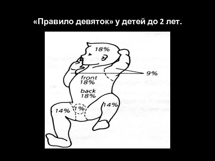 «Правило девяток» у детей до 2 лет.